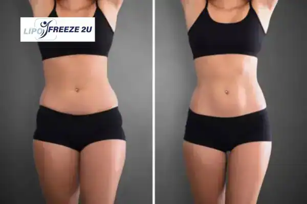 How Can LIPO FREEZE 2U Support Your Post-Pregnancy Body Recovery Bellshill?