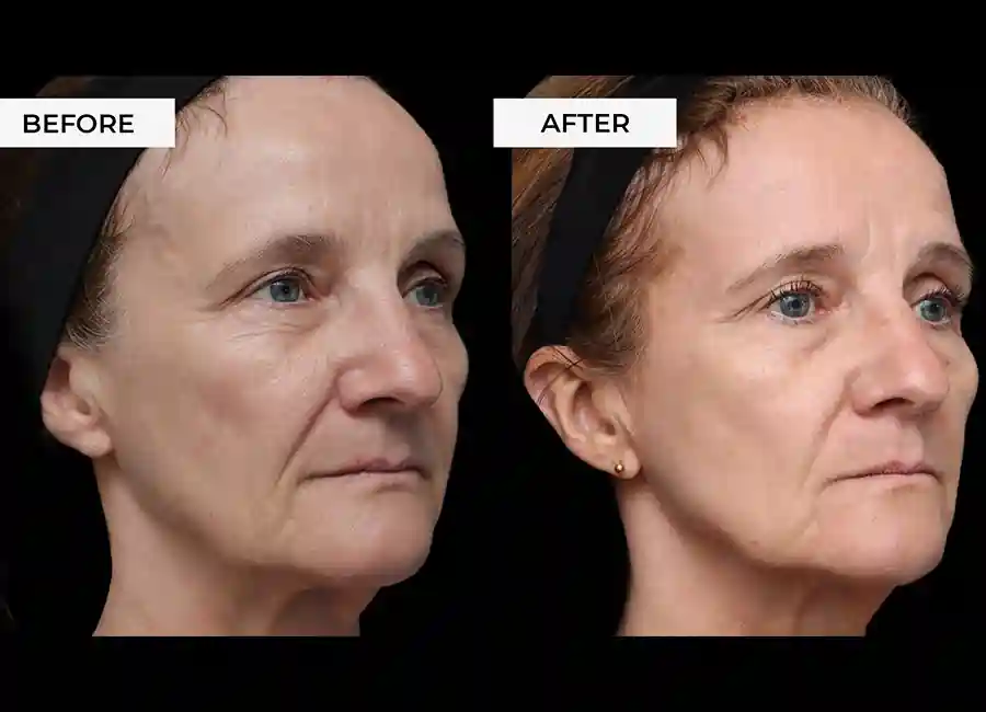 How Many RF Microneedling Sessions Will You Need to See a Difference Bellshill?