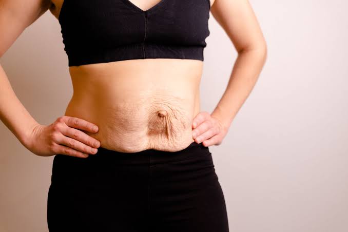 Is Surgery Really the Only Way to Repair Diastasis Recti Bellshill?