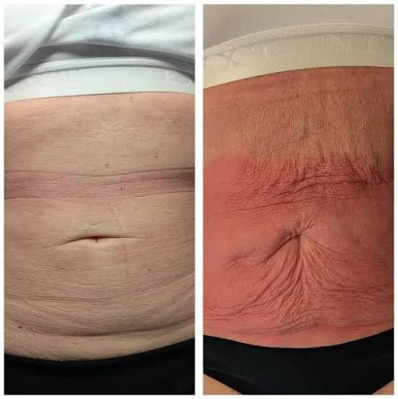 How Does RF Microneedling Improve Crepey, Thin and Uneven Skin Texture Bellshill?