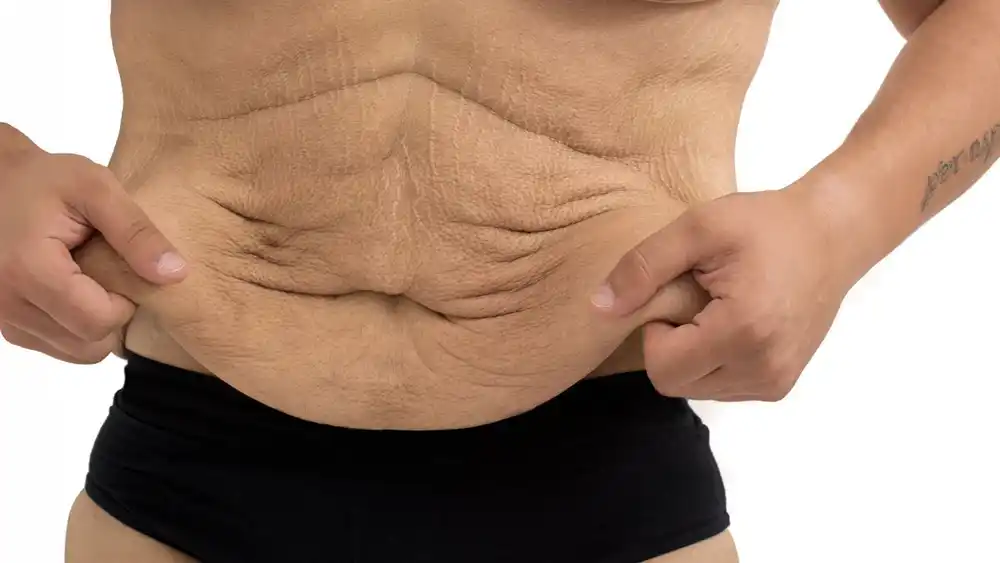 Why Does Weight Loss Medication Leave Some People With Loose or Sagging Skin Bellshill?